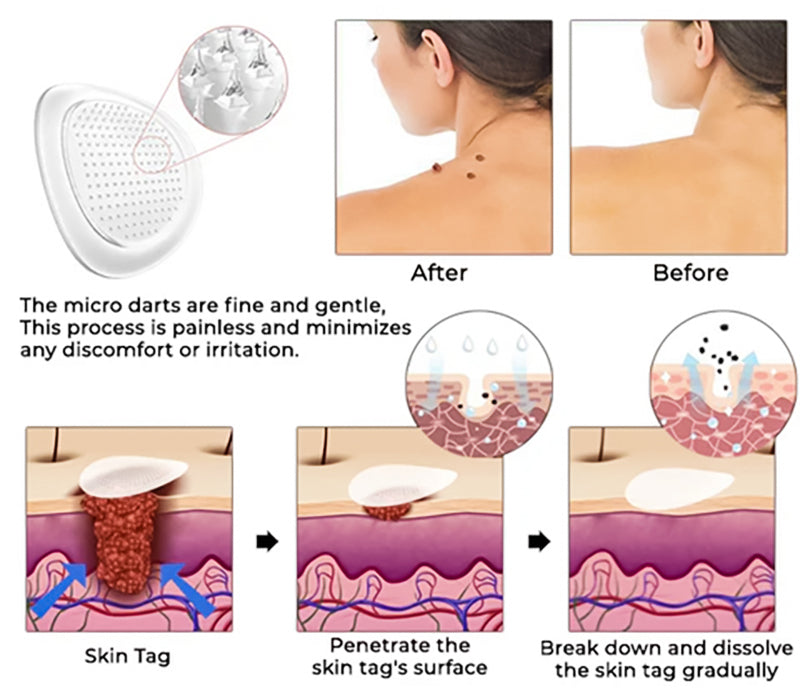 ✨ KUBOZN® MicroDarts Skin Tag Patch – Fun Shapes Edition for Gentle Care