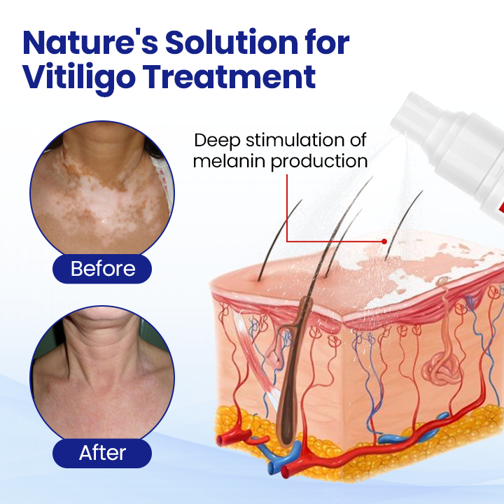 Cvreoz® Vitiligo Treatment Spray