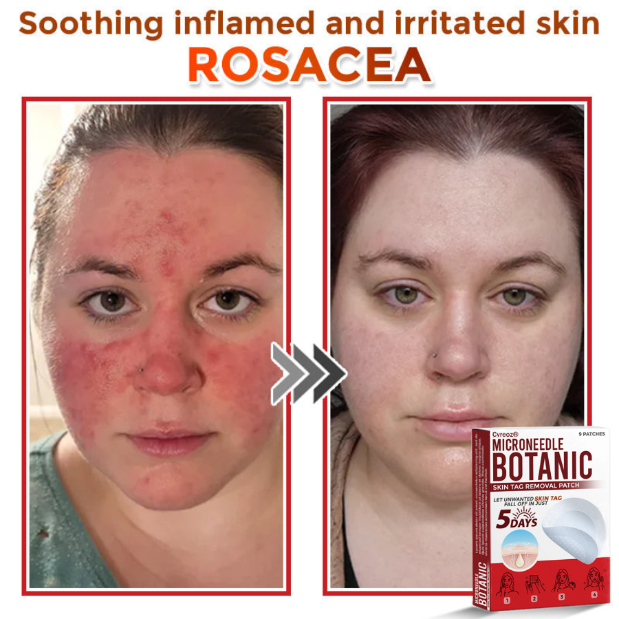 Cvreoz® MicroNeedle Botanic Skin Tag Removal Patch 🇺🇸 Made in the USA