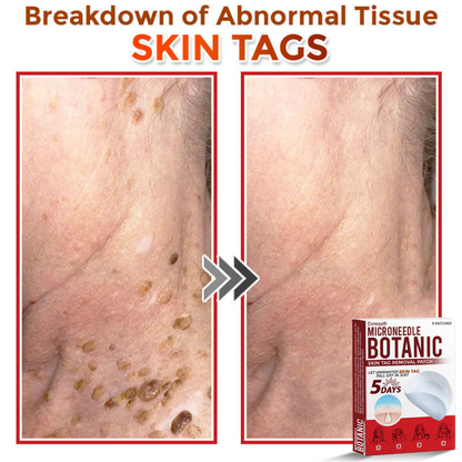 Cvreoz® MicroNeedle Botanic Skin Tag Removal Patch 🇺🇸 Made in the USA