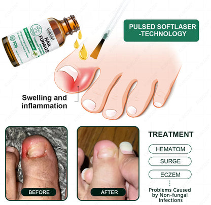 KUBOZN® Antifungal Nail Fungus Treatment Serum – Clear, Strong Nails👣