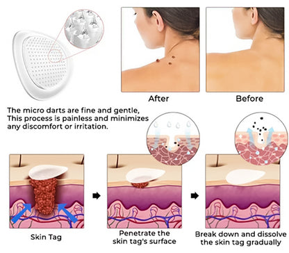 ✨ KUBOZN® MicroDarts Skin Tag Patch – Fun Shapes Edition for Gentle Care
