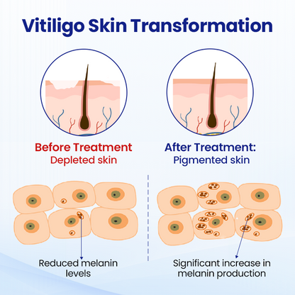 Cvreoz® Vitiligo Treatment Spray