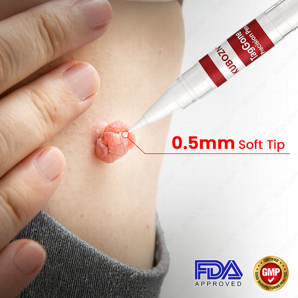 ✨KUBOZN® TagGone Precision Pen (2025 Upgrade) | Skin Tag, Mole & Wart Remover – Fast, Gentle & Scar-Free in 5 Days